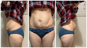 Valoracion Y Tratamiento Diastasis Abdominal 2020 Mdurance Estudio