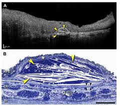 The Untold Stories Of Age Related Macular Degeneration Research Outreach