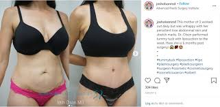 Patient #3634 mini tummy tuck before and after patient photos from la jolla plastic surgery specialist dr. What Tummy Tuck Is Right For You Josh Olson Md