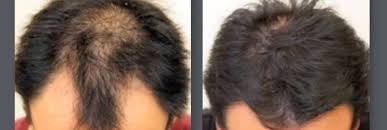 Fue Neograft Hair Restoration In 2020 Hair Transplant Procedure Neograft Hair Hair Transplant
