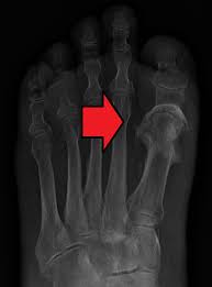 Osteomyelitis Wikipedia