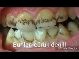 Dis Lekeleri Nasil Giderilir Renkli Tukuruk Youtube Gida Yemek Tarifleri Yemek