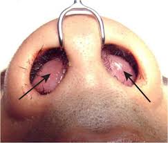 See more of septum on facebook. Nasal Septal Haematoma The Bmj