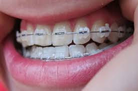 Please check out our faq page for it isn't your braces that are stained, it's the ligatures. Can Clear Braces Get Stained Orthodontists Weigh In Ncoso