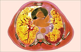 Malignant pleural mesothelioma (mpm) is an uncommon neoplasm that arises from the pleura or, rarely, the pericardium or peritoneum. A New Standard For Malignant Pleural Mesothelioma The Lancet