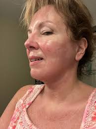 Face-lift & Neck-lift Support Group