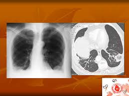 Come nel sistema venoso profondo, anche in come anticipato, l'embolia polmonare correlata a trombosi cardiaca o con sede nelle arterie polmonari è un. Embolia Polmonare Acuta Angio Tc Ppt Scaricare