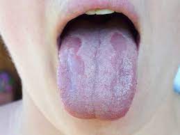 The causes may be any of those discussed above. White Tongue Causes Symptoms And Treatment
