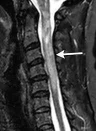 See what the internet backbone is made of and how the internet backbone transmits data across the web. Diagnostic Approach To Intrinsic Abnormality Of Spinal Cord Signal Intensity Radiographics