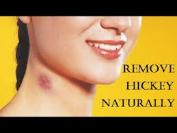 See full list on wikihow.com How To Get Rid Of Hickies Fast Remove A Hickey At Home Youtube