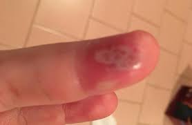 The infection caused by hsv type 1 involves the areas like mouth, lips, nose and face. What Does Herpes Look Like Pictures Treatment And Prevention