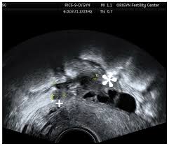 Diagnostics Free Full Text Transvaginal Ultrasound As A First Line Approach In Deep Endometriosis A Pictorial Essay Html