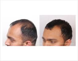 It's one that i use quite often. Hair Loss In Male Before After Results Hairmd Pune