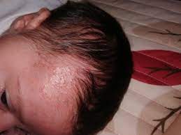 Granitos En Cabeza Y Frente Club Septiembre 2019 Embarazo Y Bebes Babycenter