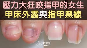 壓力大狂咬指甲的女生甲床外露與指甲黑線矯正 baby nails nail spa buy essential oils