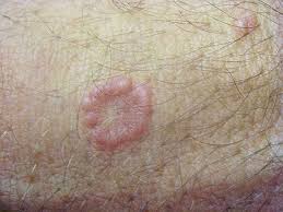 Find patient medical information for ultravate topical on webmd including its uses, side effects and safety, interactions, pictures, warnings and user ratings. Granuloma Annulare