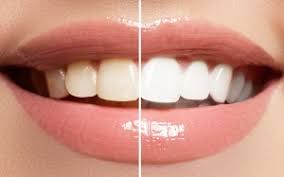 Richmond Teeth Whitening Https Richmonddental Ca