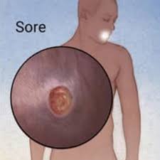 Image result for syphilis symptoms