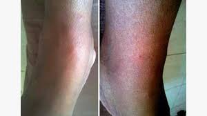 Image result for ant bite