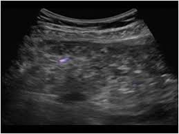 Ultrasound (us) and, above all, ct scan are useful for diagnosis. 1 7 5 Mesenteric And Peritoneal Metastases Ultrasound Cases
