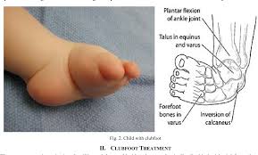Clubfoot is a foot deformity classified into three different types: Figure 2 From Study And Development Of An External Aid For Treating Congenital Talipes Equinovarus Ctev Semantic Scholar