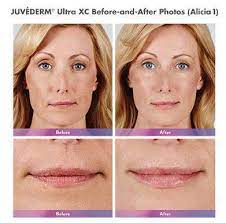 Maybe you would like to learn more about one of these? Juvederm Ultra Xc Ultra Plus Xc Before And After Bedford Tx Luxe Beauty Now