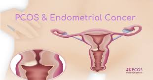 Endometrial cancer is detected at an early stage because it frequently produces abnormal vaginal following are the signs and symptoms of endometrial cancer: Pcos And Endometrial Cancer What Women Need To Know Pcos Nutrition Center