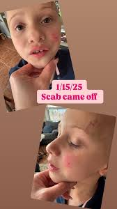 Image result for yellow scabs on the face in children
