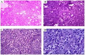 On rare occasions, they originate from the tunica vaginalis of the testis in which case they manifest as a paratesticular mass. Malignant Mesothelioma Of The Tunica Vaginalis Testis A Case Report And Literature Review