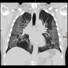 Turbine ventilator malaysia price, harga; Special Report As Virus Advances Doctors Rethink Rush To Ventilate Reuters