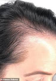 You can pick any different hairstyle to hide bald part of the scalp. Mother 52 Who Went Bald At Her Temples After Giving Birth Gets A 1 200 T Section Tattoo Daily Mail Online