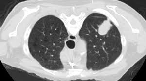 — written by it will be metastatic breast cancer. Ex Smokers Lungs Nhs Staff Shortages Brexit And Breast Cancer Genes Cancer Research Uk Cancer News