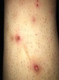Offene Locher An Meinen Beinen Was Kann Das Sein Bzw Was Kann Ich Tun Gesundheit Und Medizin Gesundheit Beine