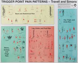 Trigger Point Injections Trigger Point Injection Technique