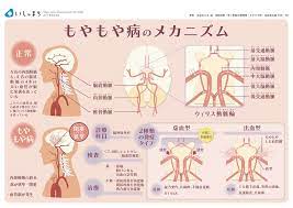 もやもや病のメカニズム infographics もやもや病 看護学生 看護ノート