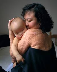 Phan Thị Kim Phúc mới chín tuổi khi cô bé bị mô tả trần truồng chạy trốn  khỏi một cuộc tấn công napalm ở miền Nam Việt Nam, trong một bức ảnh