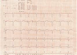 Das ekg zeigt bei vielen menschen mit einer myokarditis (herzmuskelentzündung) veränderungen, die in der regel aber unspezifisch sind. Qt Syndrom Wikipedia