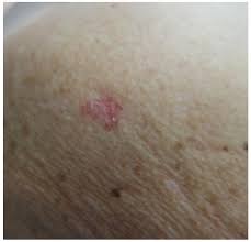 Skin Lesions — North Queensland Skin Centre