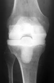 The failures likely occur because the device is designed with an abnormally smooth surface that prevents the surgical cement from properly adhering to the tibial component. Revision Total Knee Replacement Orthoinfo Aaos