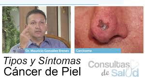 Maybe you would like to learn more about one of these? Sintomas Tratamiento Y Causas Del Cancer De Piel Especialista En Cancer Youtube