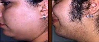 Female sideburns laser hair removal. Before And After Laser Sideburn Removal Best Laser Hair Removal Laser Hair Removal Hair Removal