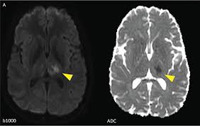 Image result for Neurosyphilis