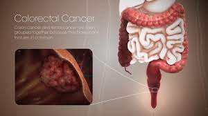 Occurs in around 48% of people with colon cancer 5. Colorectal Cancer Symptoms Causes And Treatment Scientific Animations