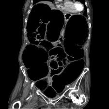Image result for Adynamic Ileus