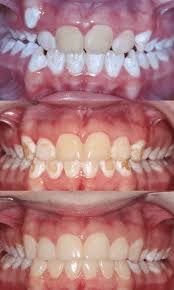 Deep cleans mouth, between teeth, and along the gum line to gently remove stains & plaque. Case Study 59 Brown Stains On Teeth Bandeen Orthodontics Battle Creek