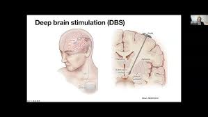 Image result for Thalamic Stimulation