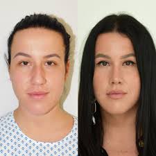 A partir de un presupuesto límite o una. Plastische Nasenoperation Rhinoplastik Yes Visage Klinik