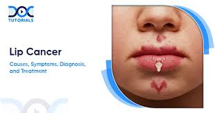 Image result for Lip Cancer