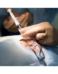 Avastin is the brand name for the drug, which is called bevacizumab. Intravitreal Injection For Macular Degeneration With Medicine Avastin