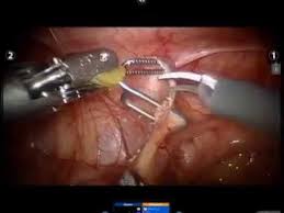 Upj Obstruction And Kidney Stone Removal All Rights Reserved By The Urology Group 2013 Youtube Kidney Stones Kidney Obstruction